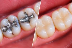 صورة توضح الفرق بين حشو الأسنان التجميلي والأملغم من خلال المقارنة المباشرة قبل وبعد العلاج. تظهر جهة اليسار ضاحكاً وضرساً ممتلئين بحشوة الأملغم الفضية (الرصاصية) التقليدية ذات المظهر المعدني البارز. توضح جهة اليمين نفس الأضراس بعد استبدال الحشوة القديمة بحشوة الكومبوزيت التجميلية المتناغمة تماماً مع لون الأسنان الطبيعي.