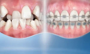 صورة توضح علاج تزاحم الأسنان من خلال المقارنة المباشرة بين حالة الفك قبل وبعد تركيب التقويم. تظهر جهة اليسار عضة غير منتظمة مع تداخل واضح وتزاحم شديد في الأسنان العلوية والسفلية. توضح جهة اليمين نفس الأسنان بعد تقويمها وحصولها على محاذاة واستقامة مثالية بفضل حواصر التقويم المعدني.