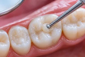 صورة مكبرة فائقة الدقة لأسنان طبيعية أثناء خضوع السن الأوسط لإجراء حشو الأسنان التجميلي (الكومبوزيت). تظهر أداة معدنية دقيقة تقوم بتشكيل ونحت طبقة طرية من مادة الكومبوزيت ذات اللون الأبيض اللؤلؤي لتندمج ببراعة مع المينا. يعكس المشهد العناية الفائقة والدقة المتناهية في استعادة الشكل الطبيعي والأملس للسن بدقة متناهية.