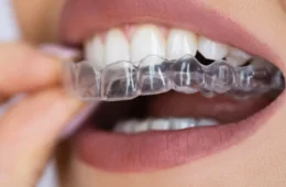 مثبت الأسنان المتحرك بعد التقويم: الدليل الكامل