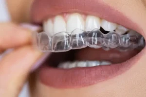 مثبت الأسنان المتحرك بعد التقويم: تظهر لقطة مقربة لامرأة تمسك بمثبت أسنان شفاف. تظهر الأصابع وهي تضع القالب البلاستيكي الشفاف القابل للإزالة فوق الأسنان العلوية مباشرة. يُستخدم هذا المثبت المتحرك للحفاظ على استقامة الأسنان ومنع عودتها لوضعها السابق بعد العلاج.