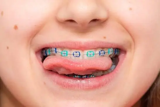 **تقويم أسنان الأطفال** صورة مقربة تُظهر ابتسامة طفل يرتدي تقويم أسنان معدنيًا تقليديًا على كل من الفكين العلوي والسفلي. يتميز التقويم بأربطة مطاطية ملونة بألوان زاهية مثل الأزرق الفاتح والأزرق الداكن، مما يضيف لمسة ممتعة ومناسبة للأطفال. يظهر الطفل وهو يخرج لسانه قليلاً، في لقطة تركز بوضوح على تفاصيل جهاز التقويم المثبت على أسنانه البيضاء.