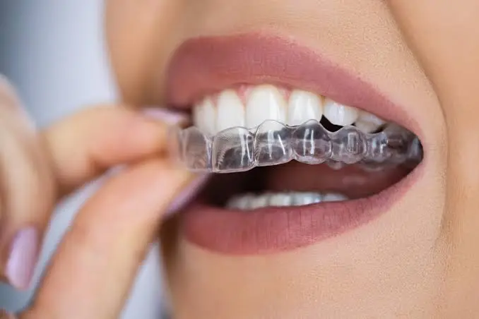 **تقويم الأسنان المتحرك** تُظهر الصورة لقطة مقربة لامرأة تضع أو تزيل قالب تقويم أسنان شفافًا من أسنانها العلوية. تُستخدم أصابع اليد ذات طلاء الأظافر الوردي للإمساك بالقالب المرن فوق صف الأسنان البيضاء. يبرز هذا المشهد الميزة الأساسية لتقويم الأسنان المتحرك كخيار علاجي سري وغير مرئي تقريبًا.