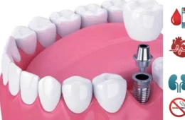 الأمراض المؤثرة على زراعة الأسنان: دليلك الشامل
